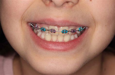 Brackets